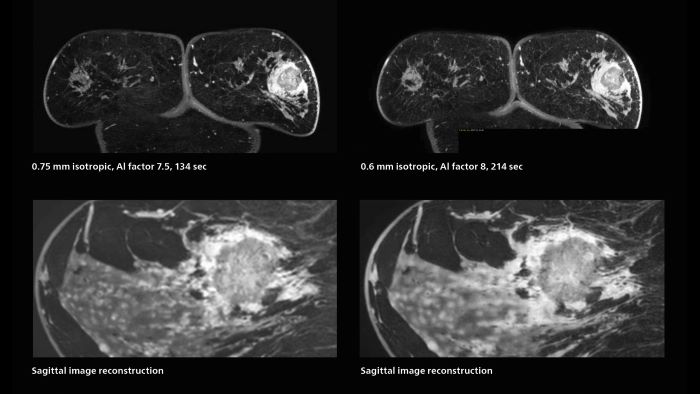 Fast AI-enabled MRI of breast cancer: comparing 3D acquisitions with 0.75 mm and 0.6 mm isotropic voxels.