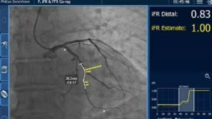 iFR Clinical data & Patient Study