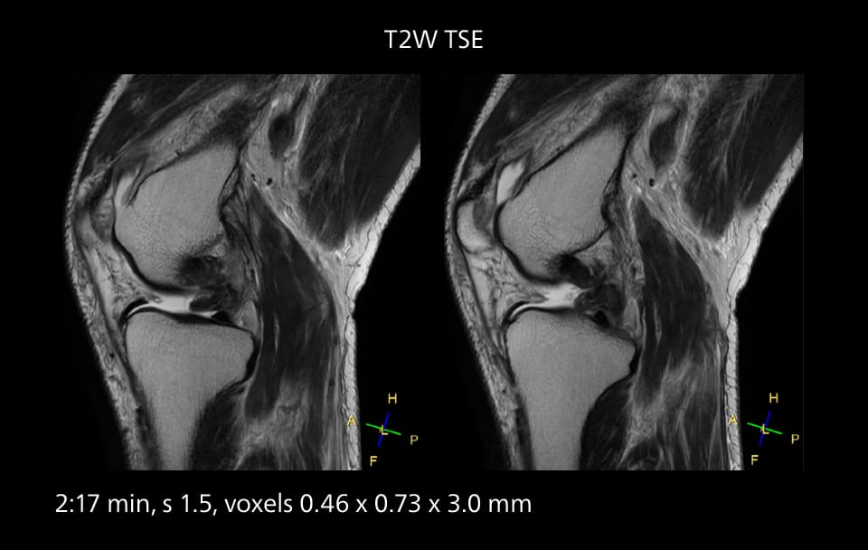 Knee mri three